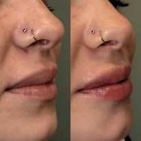 Side-by-side close-up of a nose with a nose ring and slightly parted lips, before and after comparison