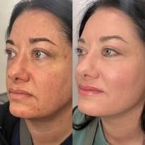Side-by-side facial profile before and after cosmetic treatment, with smoother skin and a softer expression