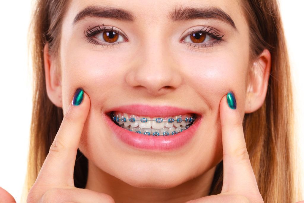 Close-up of a smiling person showing metal braces and pointing at their teeth.