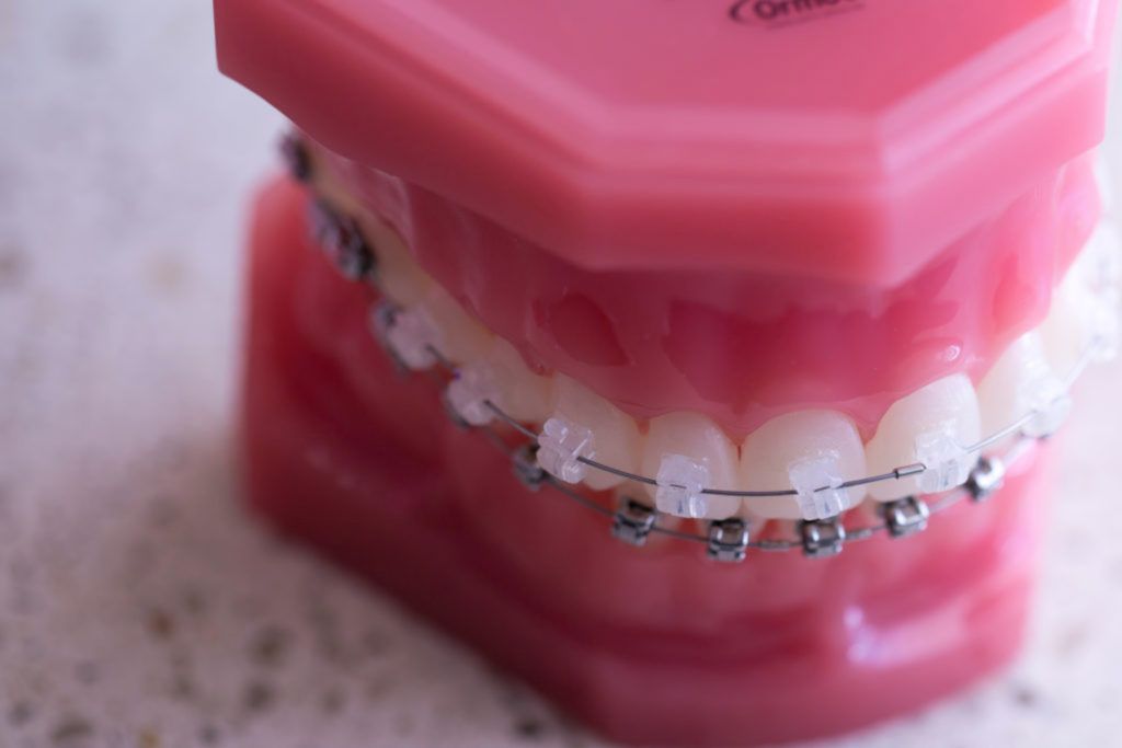 Pink dental model with metal braces on white teeth