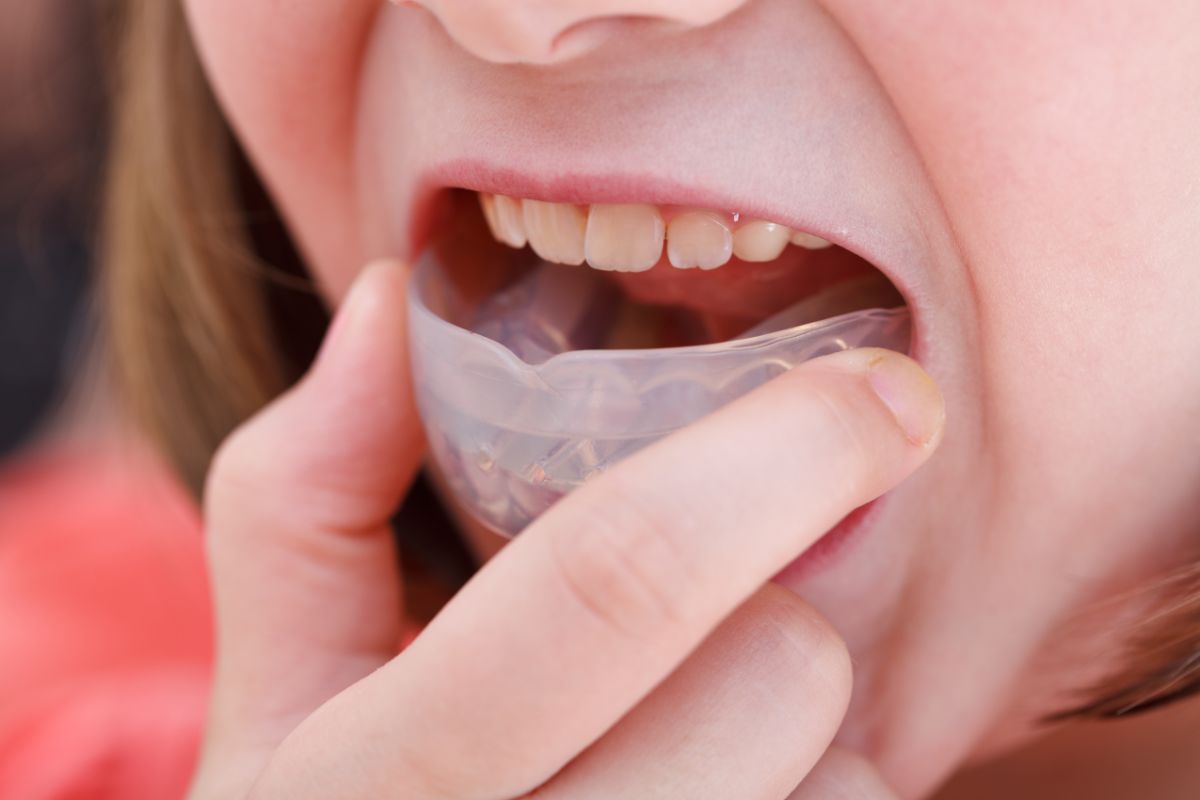 Child fitting a clear dental aligner over their teeth in a close-up view
