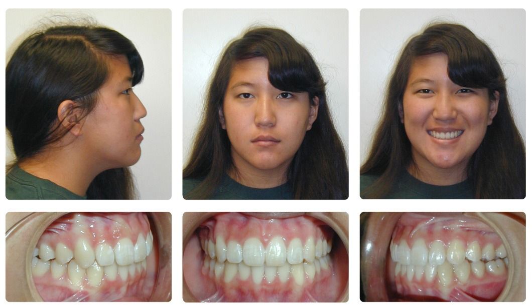 Patient smile after Invisalign treatment at Brodsky Orthodontics