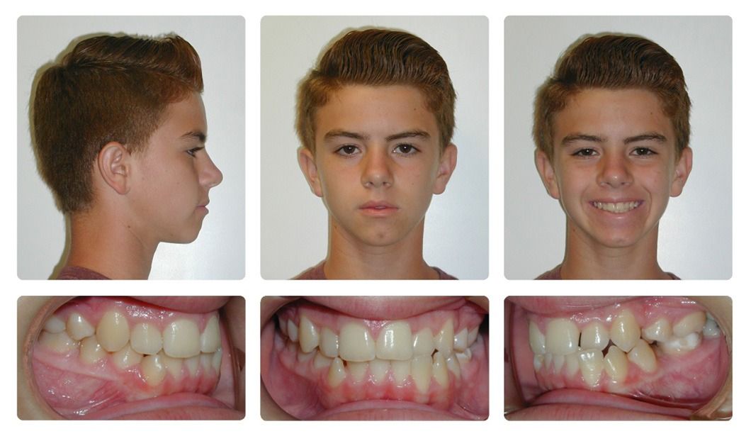 Invisalign Patient 10 — After. Class 1 space closure from previous 4 Bicuspid Extractions, treated with Invisalign