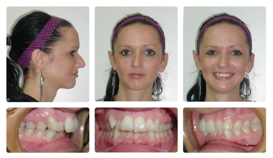 Invisalign Patient 11 — After. Class 2 Division 2, treated with extraction of 2 Upper First Bicuspids and Invisalign