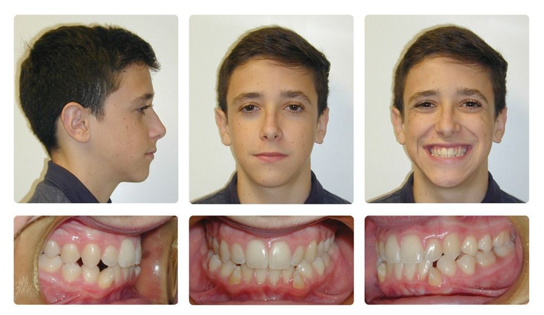 Invisalign Patient 12 — After. Class 3, treated with extraction of 2 Lower First Bicuspids and Invisalign