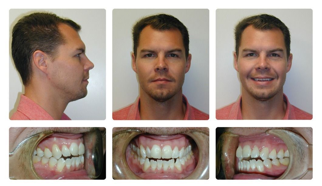 Invisalign Patient 13 — After. Class 1 crowding with open bite, treated with Invisalign