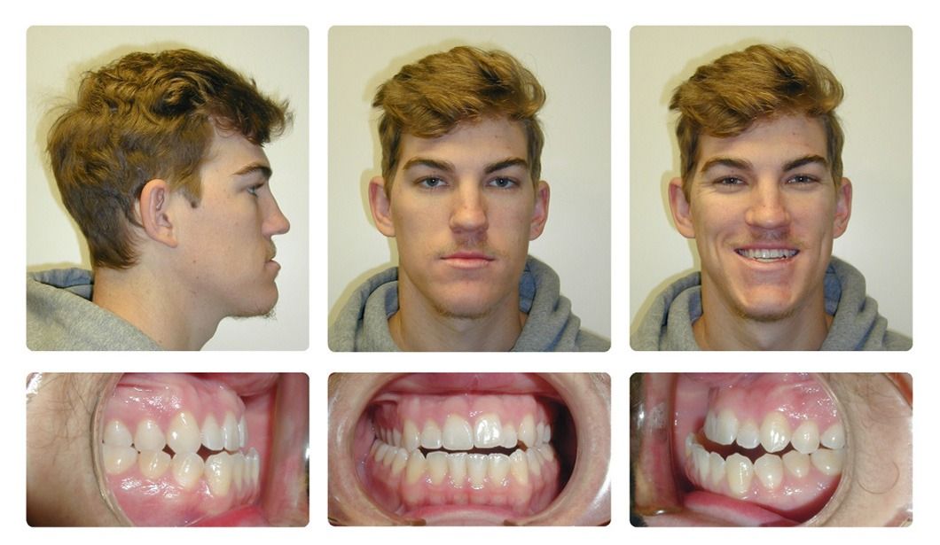 Invisalign Patient 14 — After. Class 3 with posterior crossbite, treated with jaw surgery and Invisalign