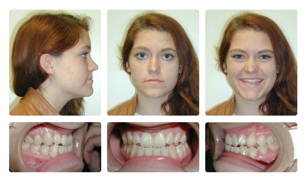 Invisalign Patient 15 — After. Class 3 crowding, treated with jaw surgery and Invisalign