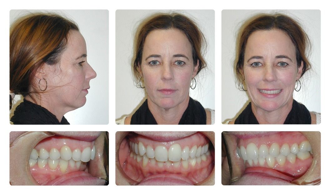 Invisalign Patient 16 — After. Class 2, treated with jaw surgery and Invisalign