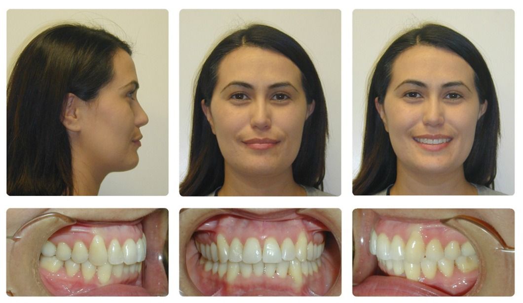 Invisalign Patient 2 — After. Class 1 crowding without extractions, treated with Invisalign