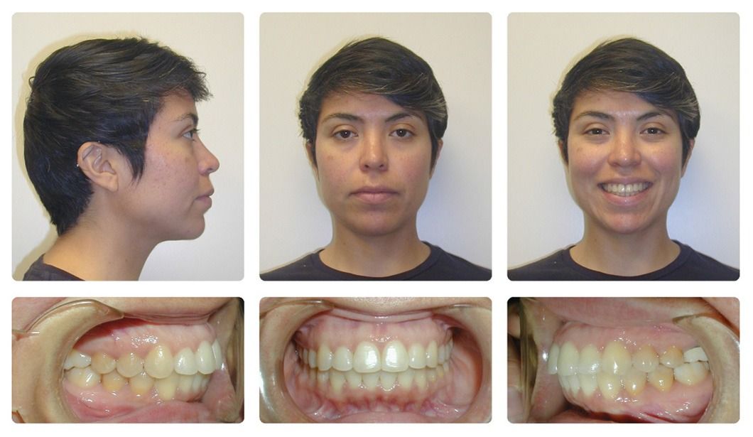 Invisalign Patient 3 — After. Class 1 crowding without extractions, treated with Invisalign