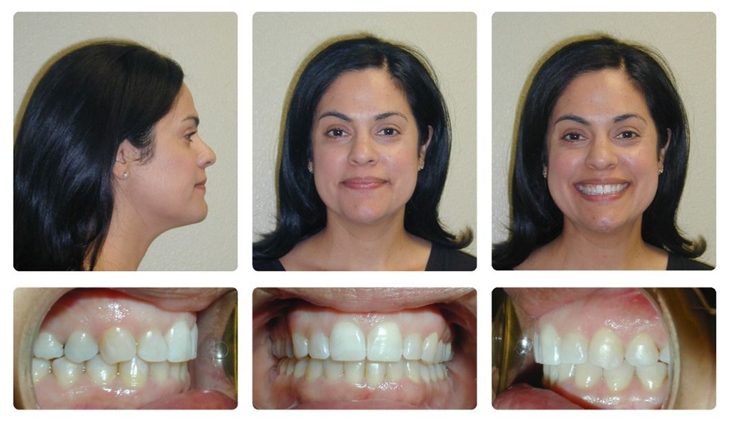 Invisalign Patient 4 — After. Class 1 crowding without extractions, treated with Invisalign