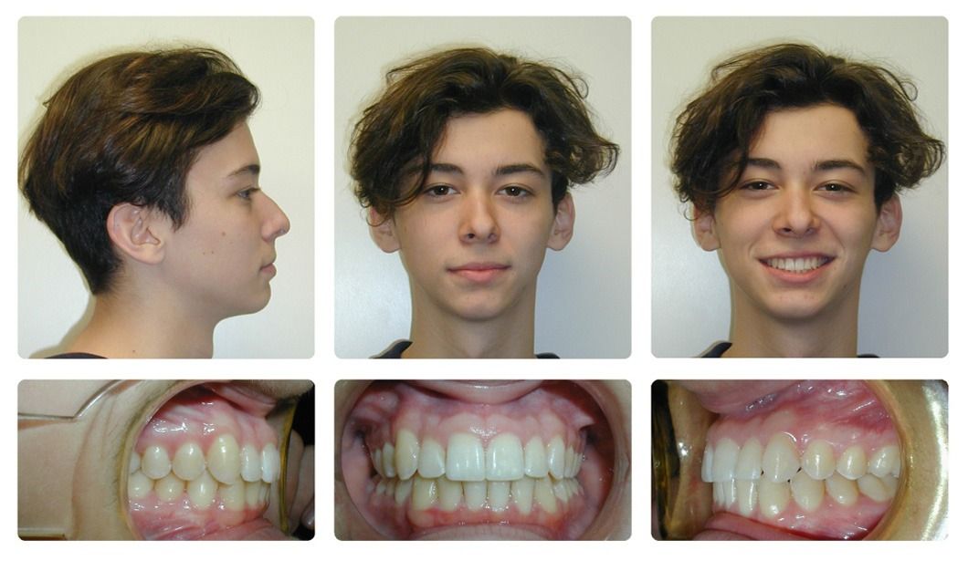 Invisalign Patient 5 — After. Class 1 crowding with deep overbite, treated with Invisalign