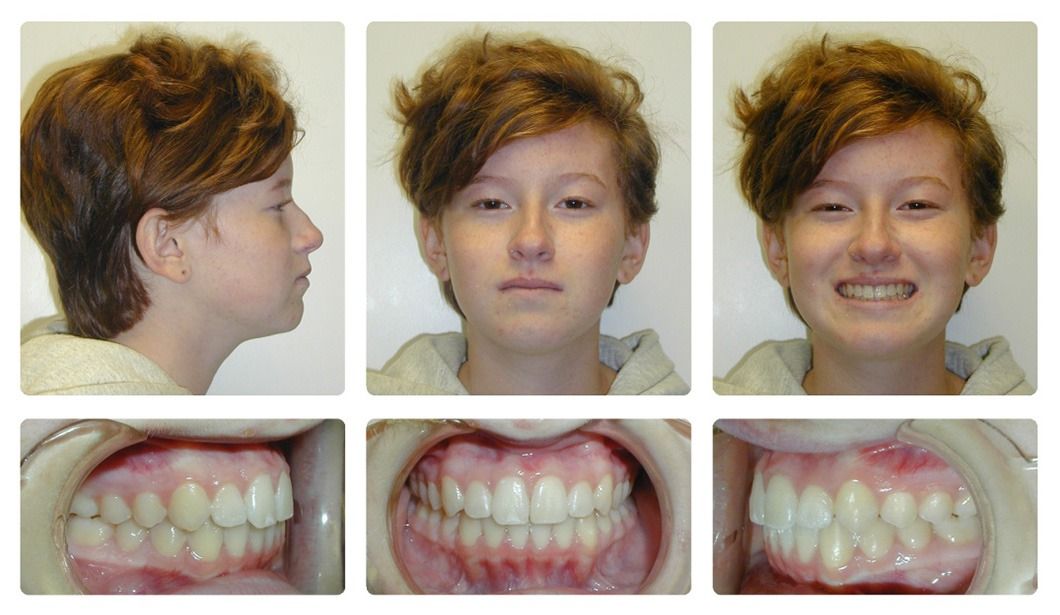 Invisalign Patient 6 — After. Class 1 crowding with deep overbite and crossbite, treated with Invisalign