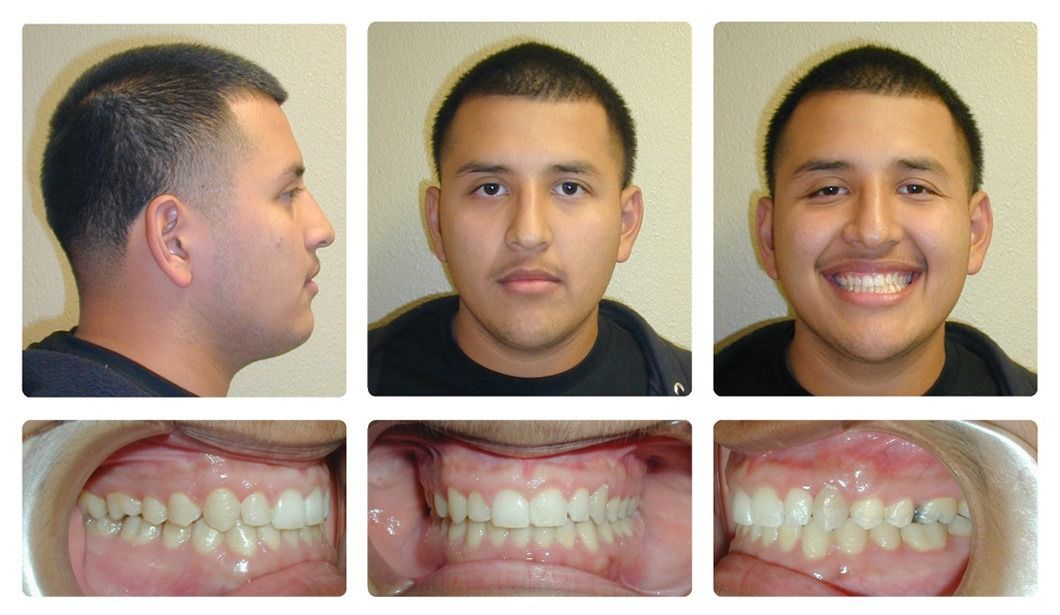 Invisalign Patient 7 — After. Class 1 crowding with anterior crossbite, treated with Invisalign