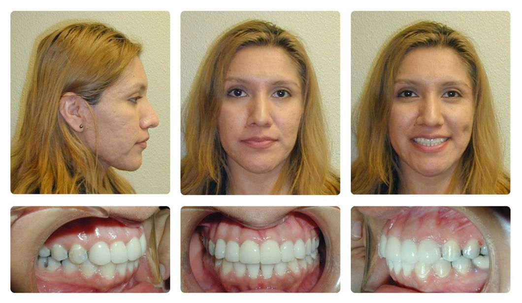 Invisalign Patient 8 — After. Class 1 crowding with anterior and posterior crossbites, treated with Post-Invisalign Restorations