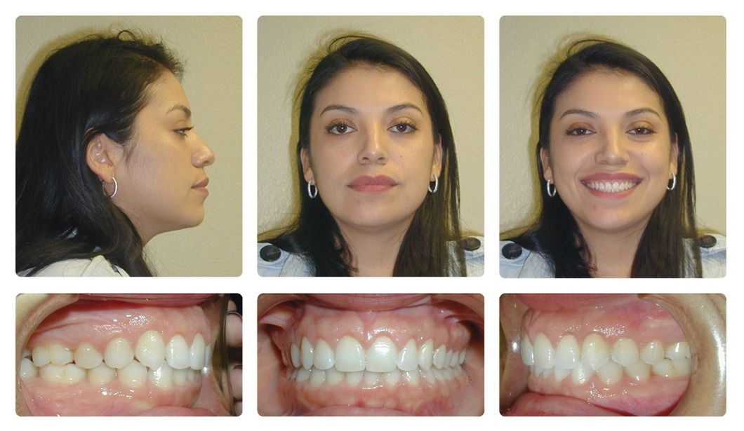 Invisalign Patient 9 — After. Class 1 spacing, treated with Gingivectomy and Invisalign