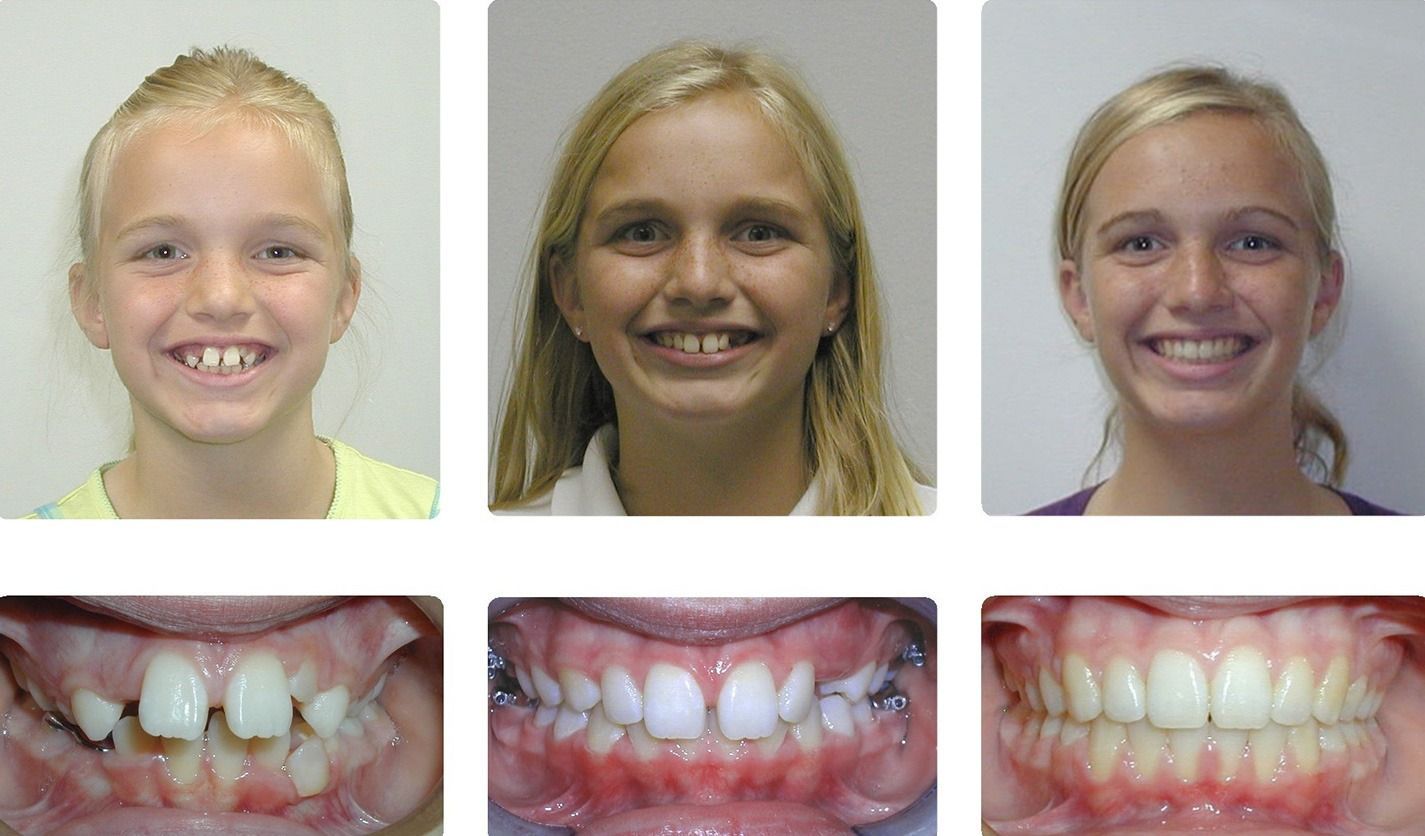 Braces patient before and after two-phase treatment at Brodsky Orthodontics