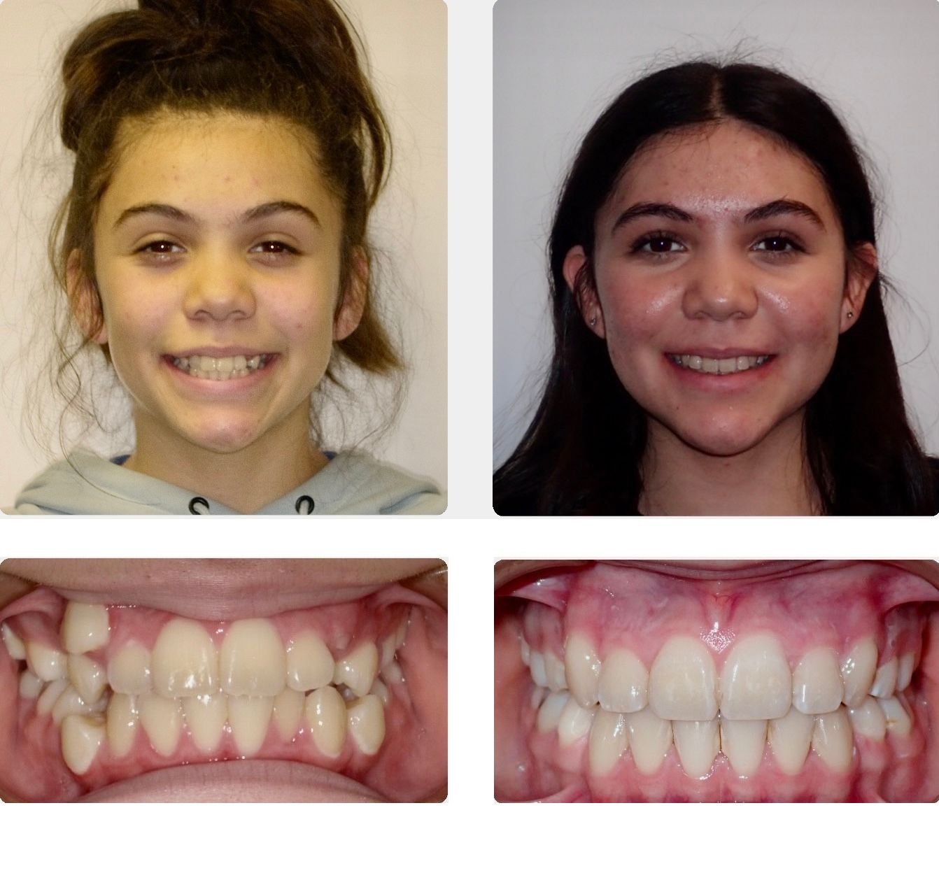 Braces Patient 10 — Before & After. Severe crowding treated with extractions and braces