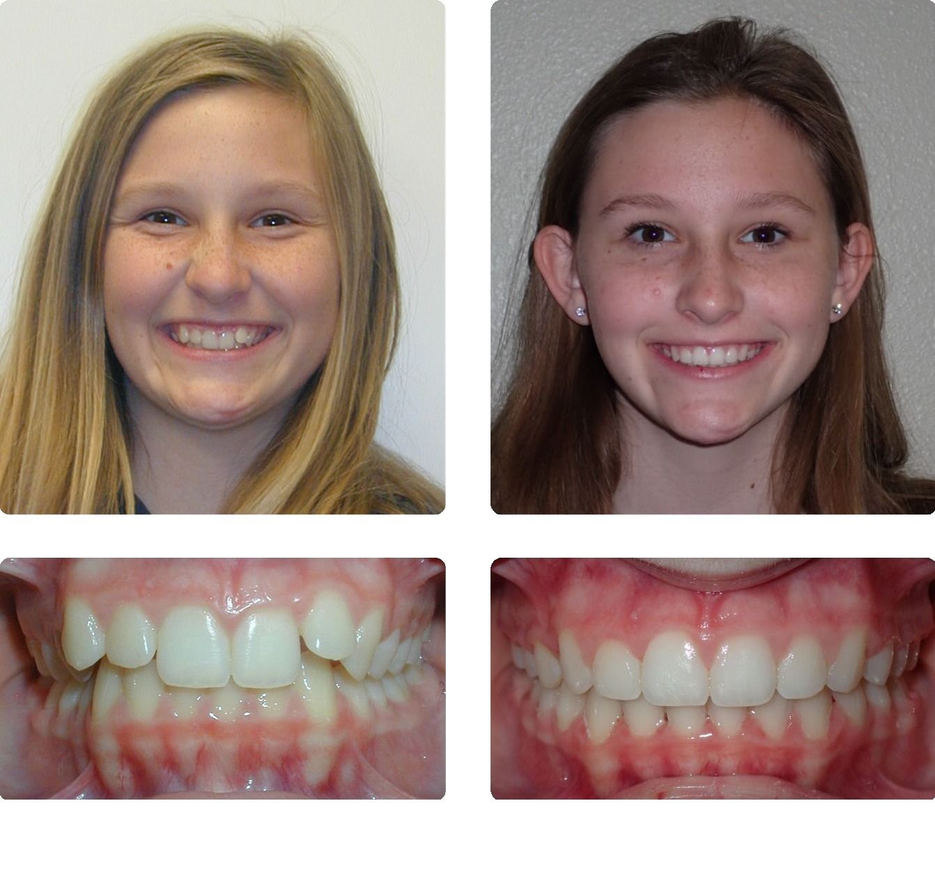 Braces Patient 11 — Before & After. Deep overbite with midline shift treated with braces