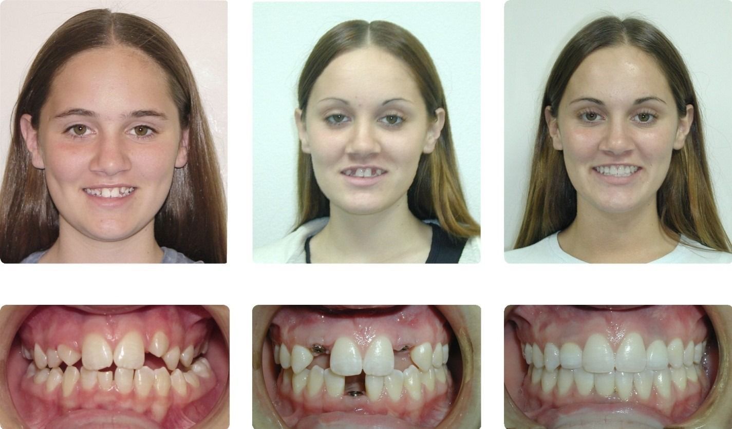 Braces Patient 2 — Before & After. Missing 3 teeth restored with implants after braces