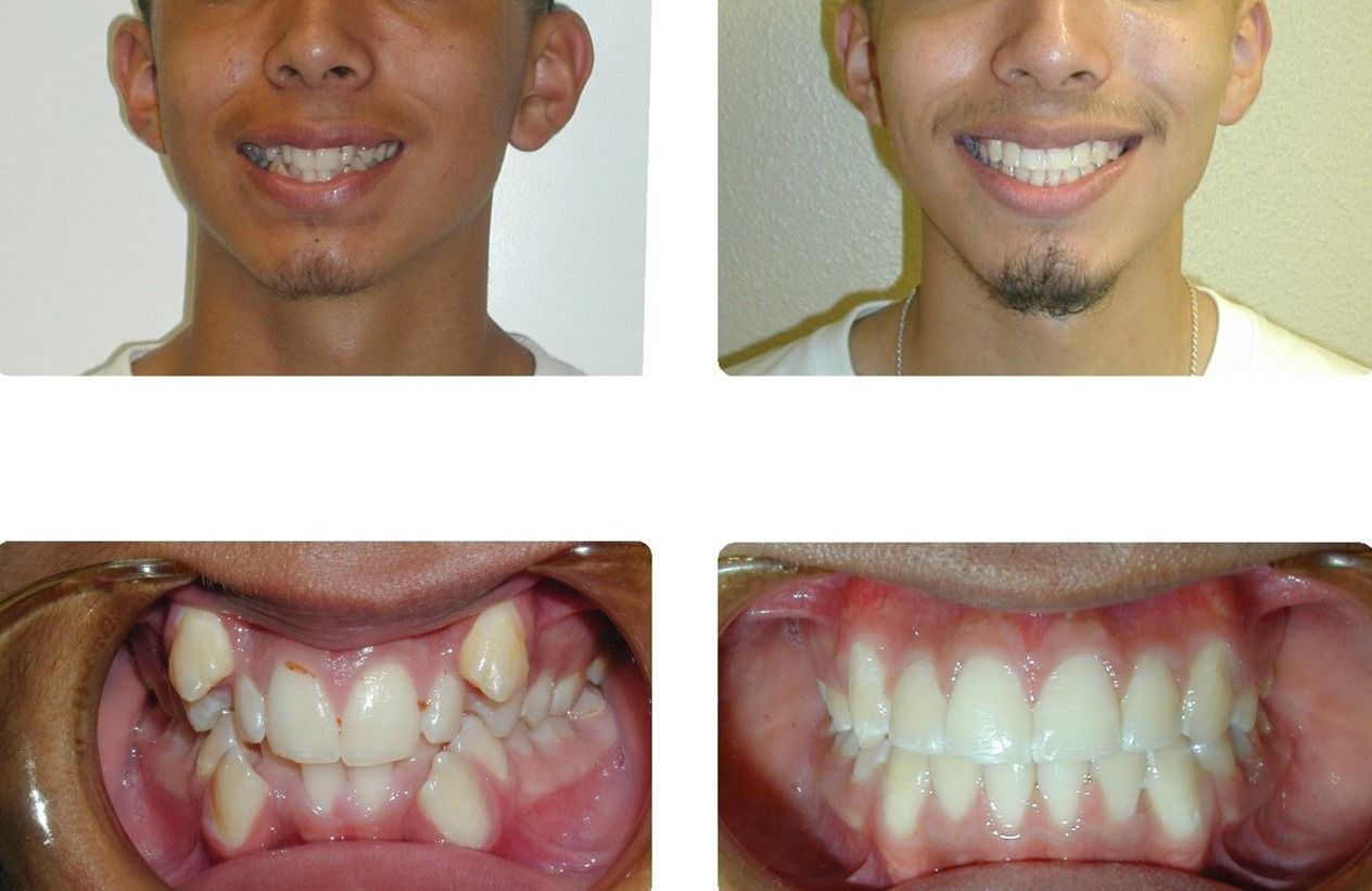 Braces Patient 3 — Before & After. Severe crowding with blocked out cuspids treated with extractions and braces