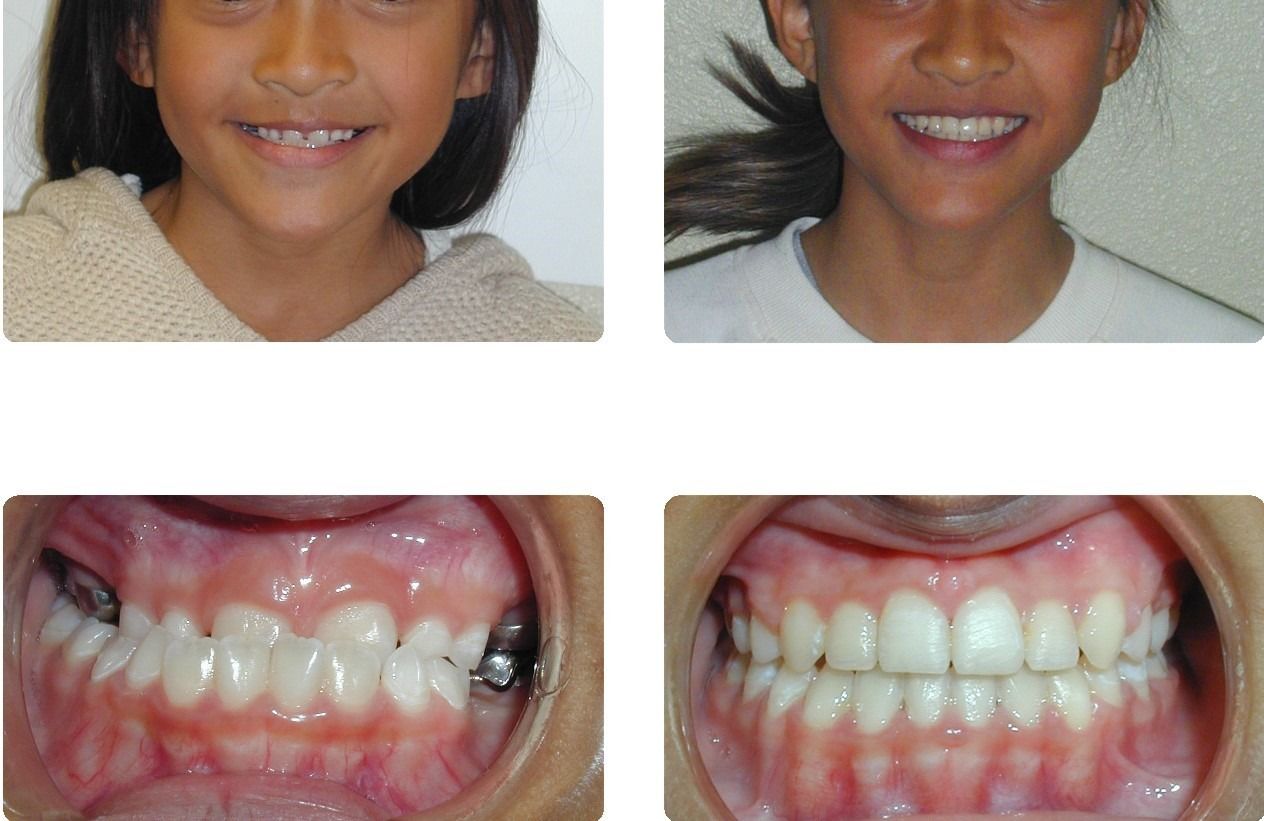 Braces Patient 4 — Before & After. Complete underbite and posterior crossbite treated with braces