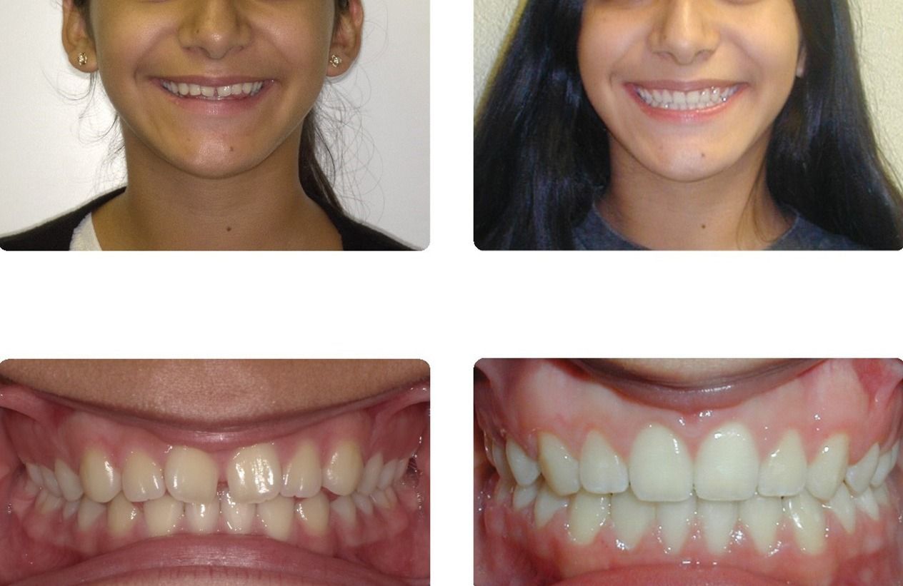 Braces Patient 5 — Before & After. Spaces between teeth corrected with braces