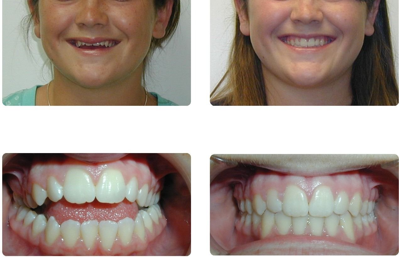 Braces Patient 6 — Before & After. Anterior openbite with crossbite corrected using braces