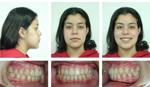 Braces Patient 7 — After Braces. Severe underbite treated with braces in combination with orthognathic surgery