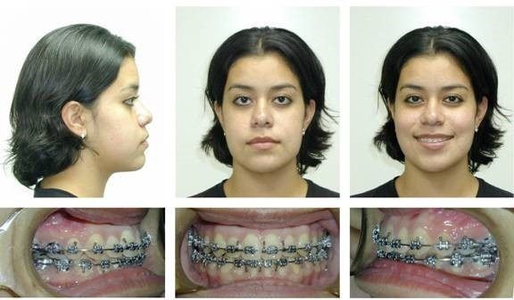 Braces Patient 7 — After Surgery. Severe underbite treated with braces in combination with orthognathic surgery