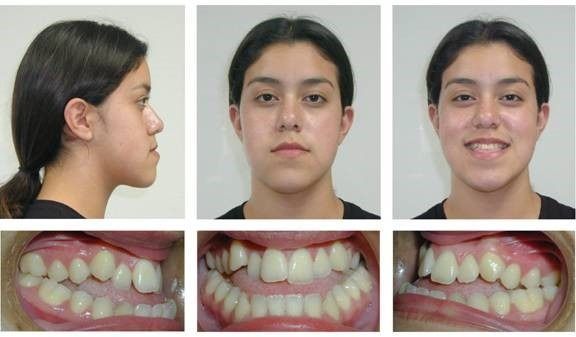 Braces Patient 7 — Before Braces. Severe underbite treated with braces in combination with orthognathic surgery