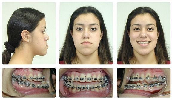 Braces Patient 7 — Before Surgery. Severe underbite treated with braces in combination with orthognathic surgery