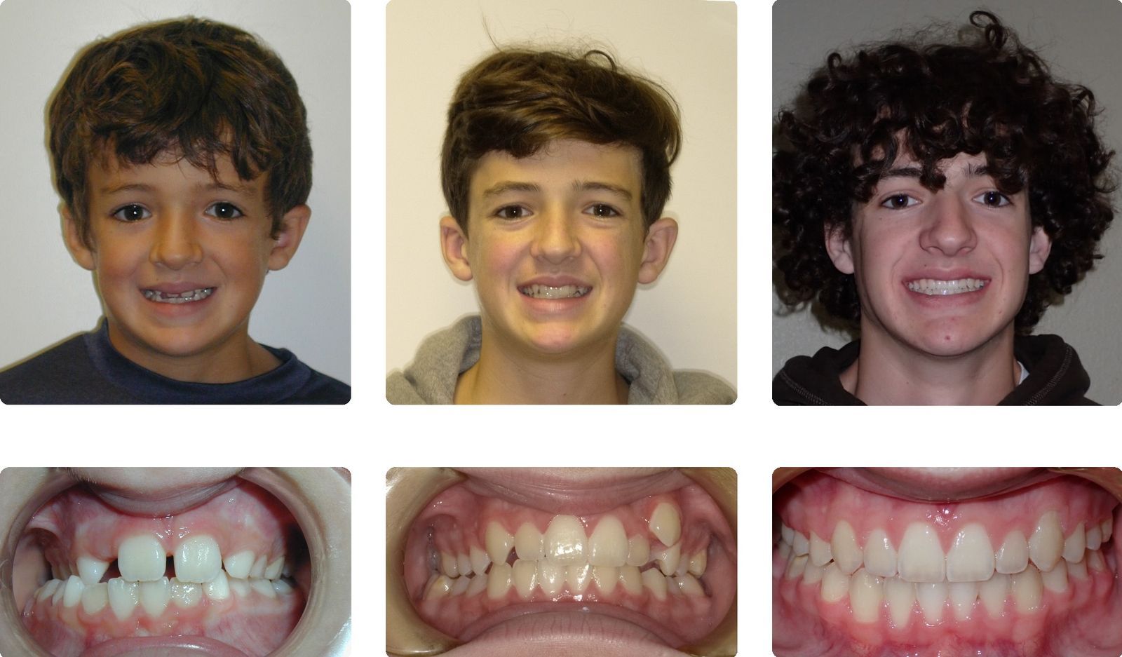 Braces Patient 8 — Before & After. Crossbite with crowding treated with 2 phases of braces