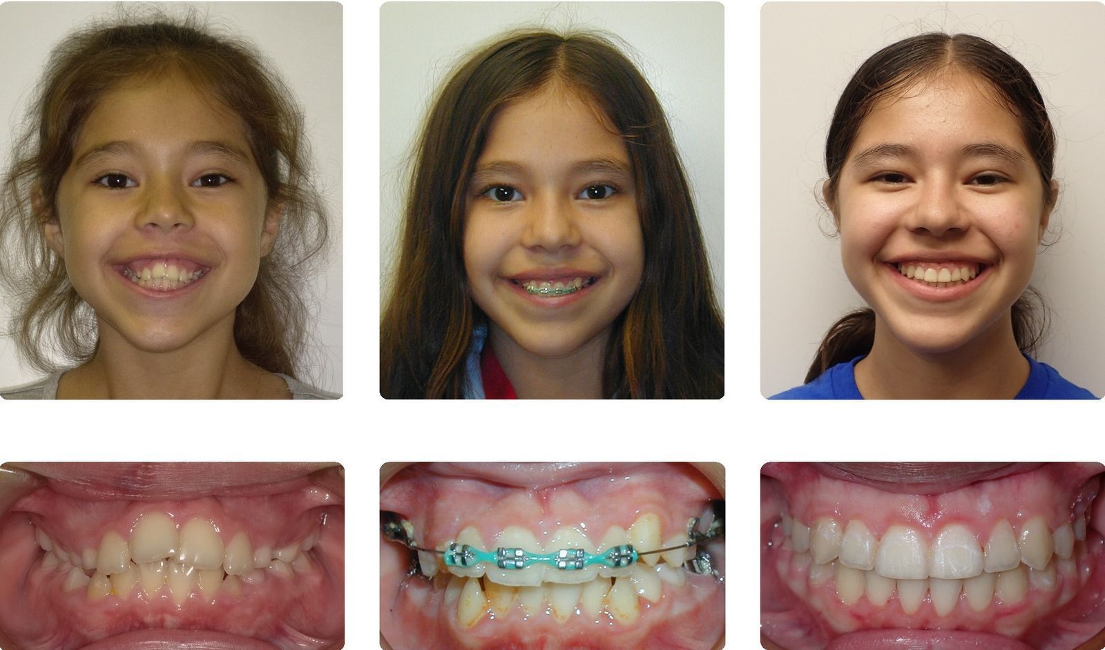 Braces Patient 9 — Before & After. Narrow upper arch with reverse smile arc treated with 2 phases of braces