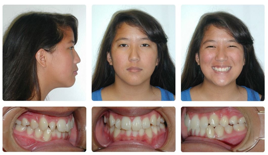 Patient smile before Invisalign treatment at Brodsky Orthodontics