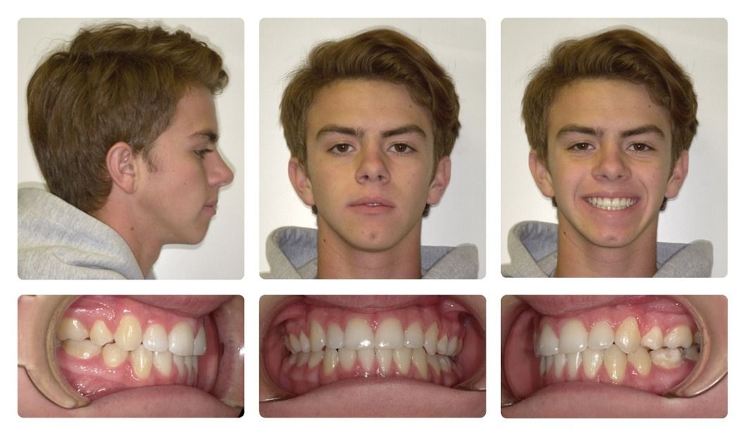 Invisalign Patient 10 — Before. Class 1 space closure from previous 4 Bicuspid Extractions, treated with Invisalign