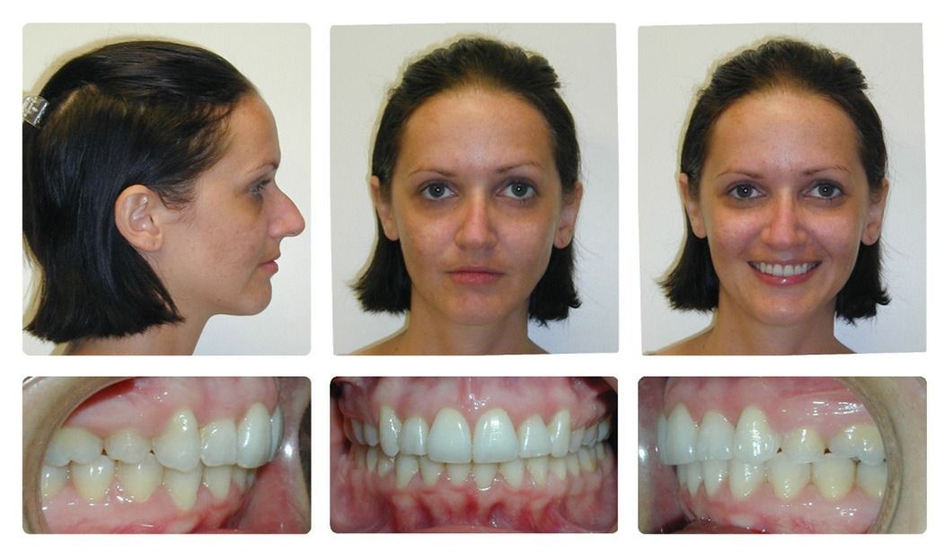 Invisalign Patient 11 — Before. Class 2 Division 2, treated with extraction of 2 Upper First Bicuspids and Invisalign
