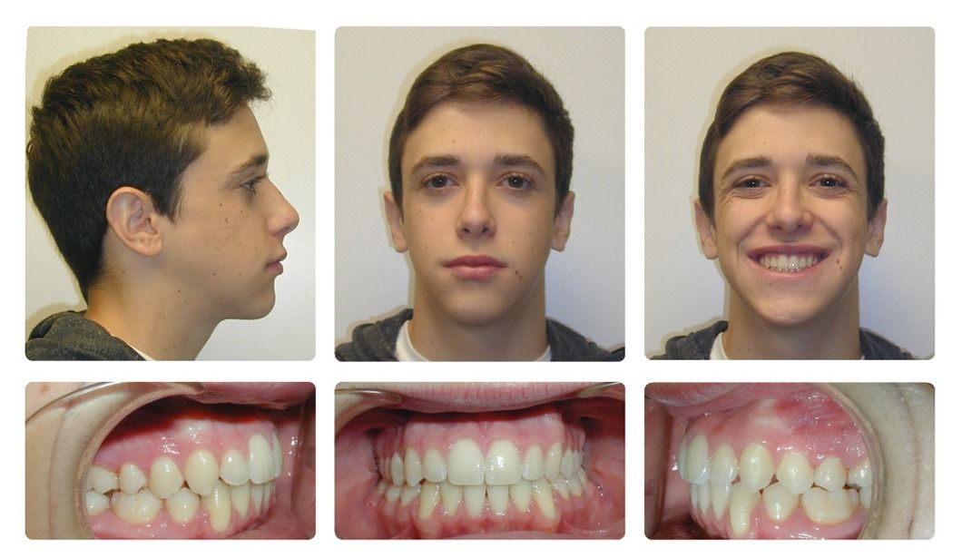 Invisalign Patient 12 — Before. Class 3, treated with extraction of 2 Lower First Bicuspids and Invisalign