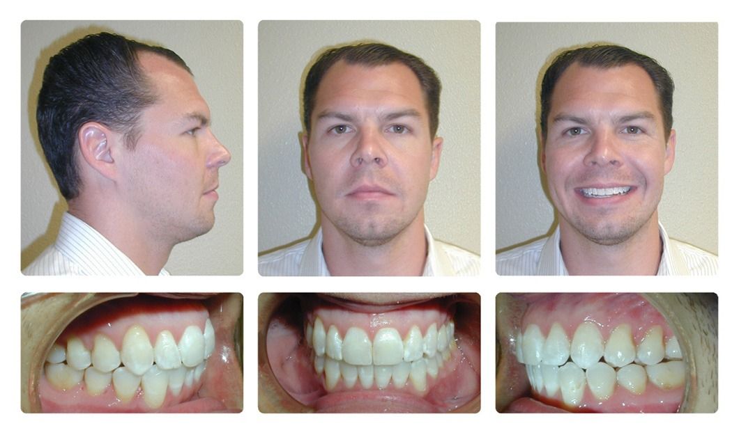 Invisalign Patient 13 — Before. Class 1 crowding with open bite, treated with Invisalign