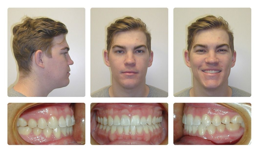 Invisalign Patient 14 — Before. Class 3 with posterior crossbite, treated with jaw surgery and Invisalign