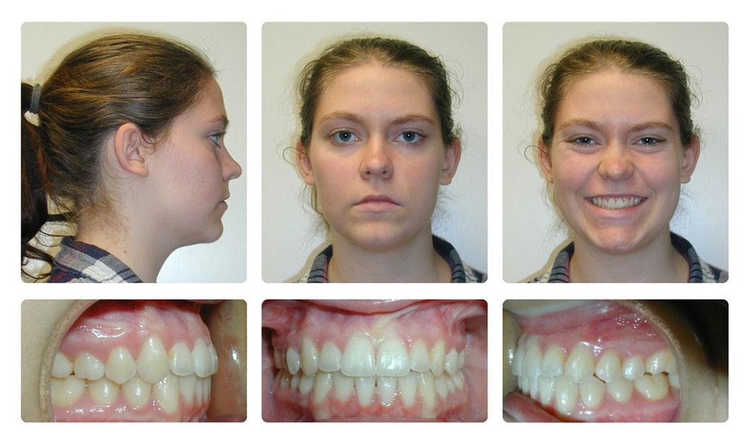 Invisalign Patient 15 — Before. Class 3 crowding, treated with jaw surgery and Invisalign