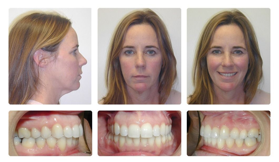 Invisalign Patient 16 — Before. Class 2, treated with jaw surgery and Invisalign