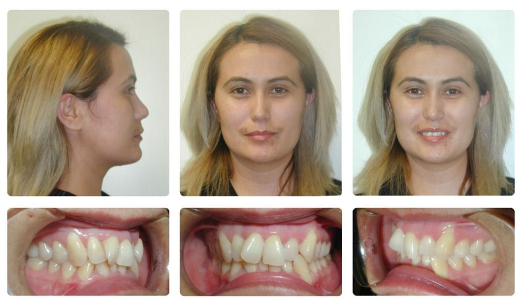 Invisalign Patient 2 — Before. Class 1 crowding without extractions, treated with Invisalign