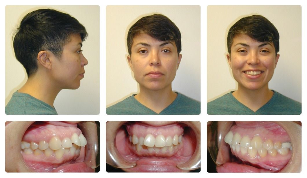 Invisalign Patient 3 — Before. Class 1 crowding without extractions, treated with Invisalign