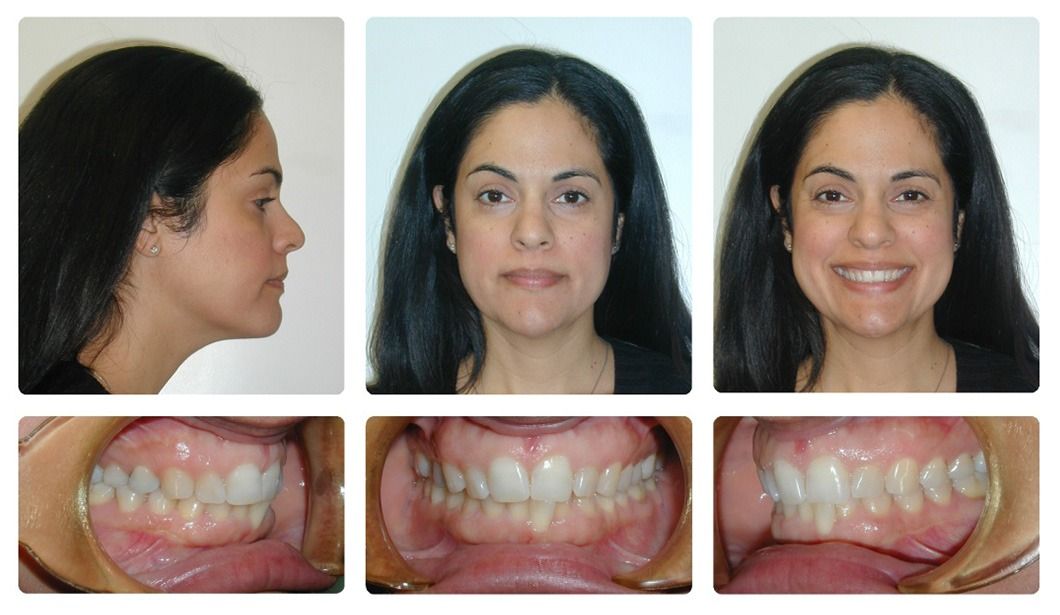 Invisalign Patient 4 — Before. Class 1 crowding without extractions, treated with Invisalign
