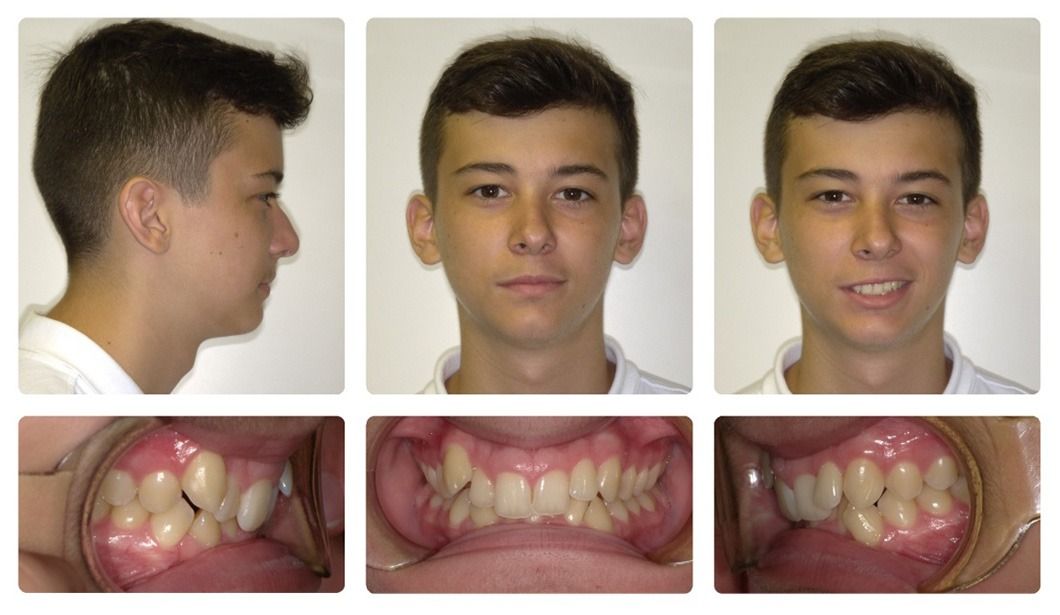Invisalign Patient 5 — Before. Class 1 crowding with deep overbite, treated with Invisalign