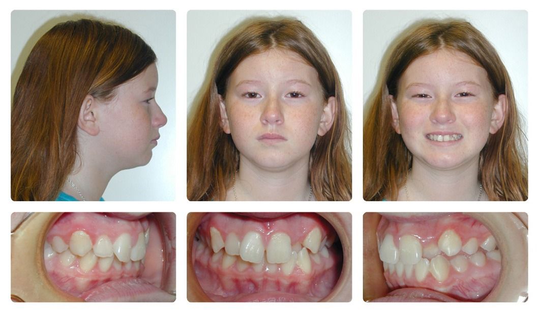 Invisalign Patient 6 — Before. Class 1 crowding with deep overbite and crossbite, treated with Invisalign