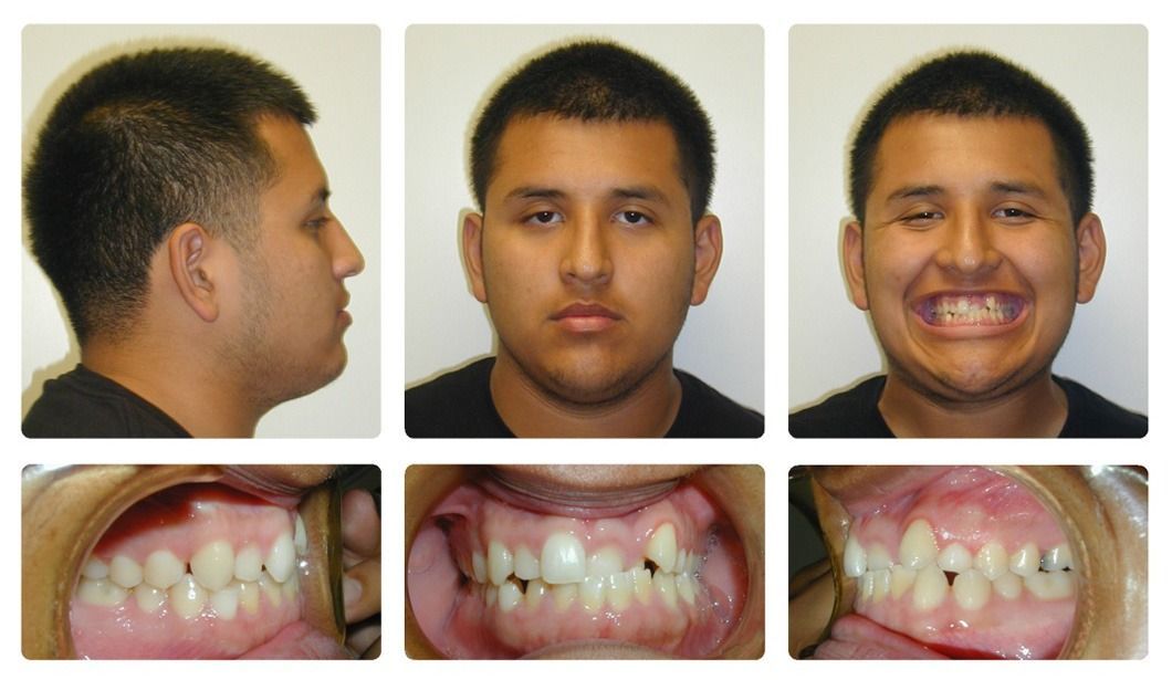 Invisalign Patient 7 — Before. Class 1 crowding with anterior crossbite, treated with Invisalign