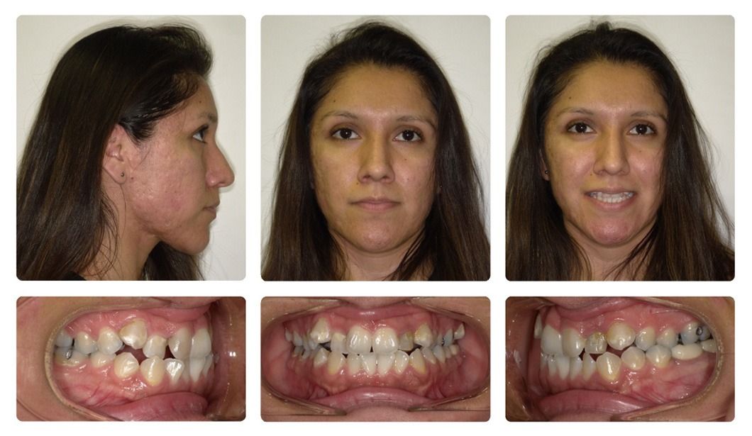 Invisalign Patient 8 — Before. Class 1 crowding with anterior and posterior crossbites, treated with Post-Invisalign Restorations